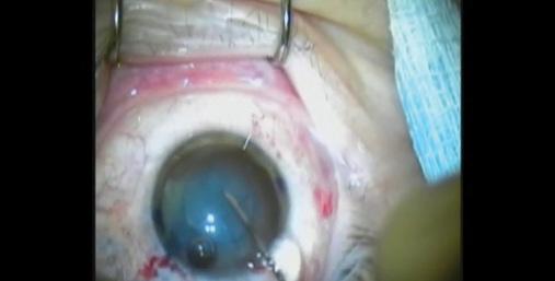 Figure 1. After staining the capsule with trypan blue dye, Dr. Gulani checks the capsulotomy.